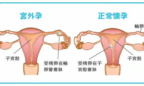 不是所有的宫外孕都需要手术！