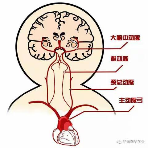 ［爱脑科普］什么是脑卒中