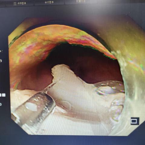 消化内镜显神通—“镜到刺出”