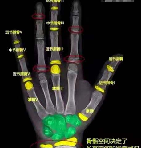 【儿童保健科】骨龄——孩子长高的秘密