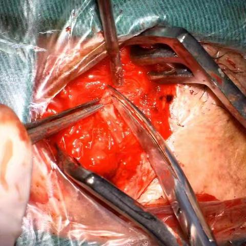 襄阳市首例！30分钟微创手术成功治疗顽固性三叉神经痛！