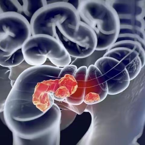 身体有这几个情况，该做胃肠镜了