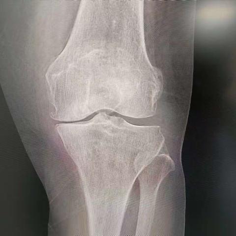 膝关节置换术康复