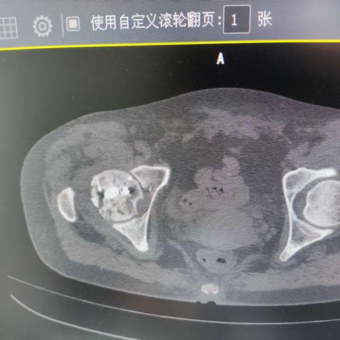 股骨头坏死的康复