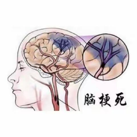 脑梗死的健康宣教