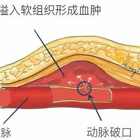 动静脉内瘘假性动脉瘤还开刀治疗吗？