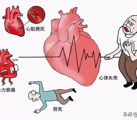 急性冠脉综合征