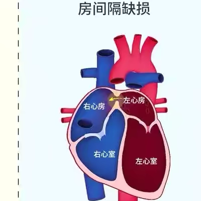 房间隔缺损