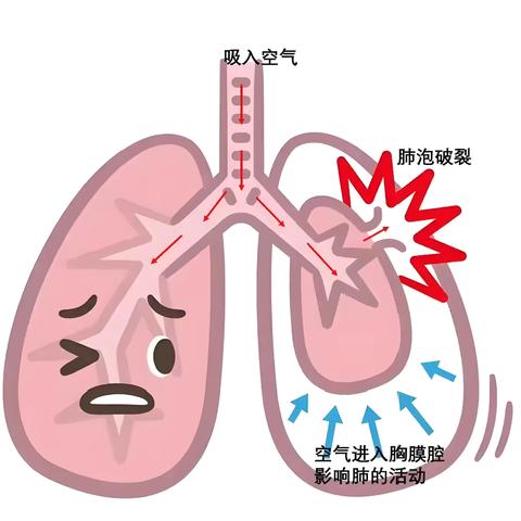 会呼吸的“痛”——什么是自发性气胸？