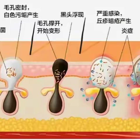 皱纹怎么去掉？消除的最简单的方法是什么？