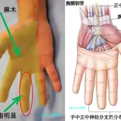 腕管综合征
