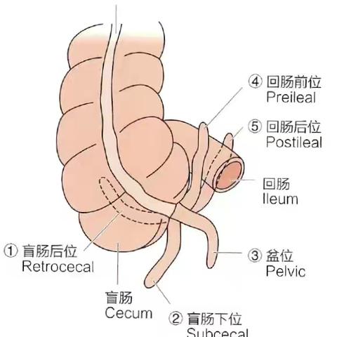 阑尾炎CT诊断