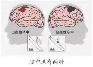 卒中-人类健康的第一杀手
