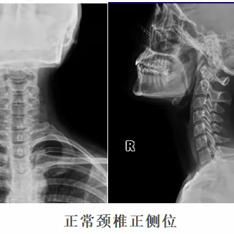 不可忽视的颈椎病