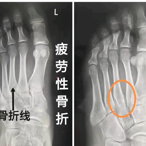 特殊类型骨折——疲劳性骨折