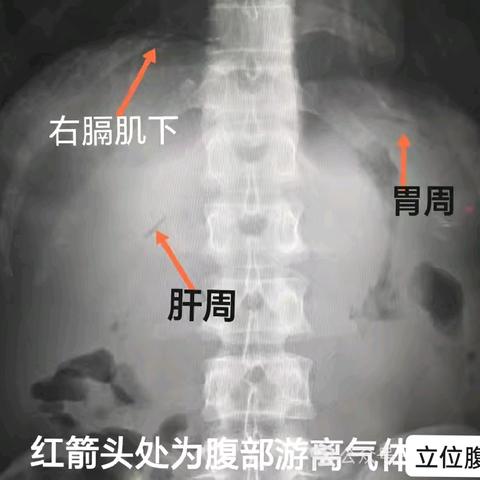 腹部立位平片能看啥？不止是肠梗阻和消化道穿孔。