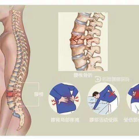 腰椎骨折的健康宣教