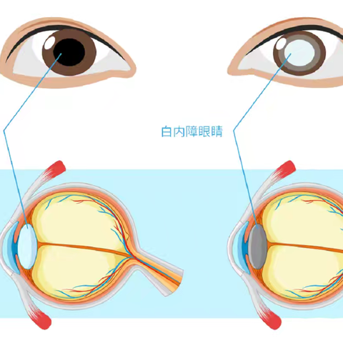 关于白内障--不要让“白雾”遮住视线