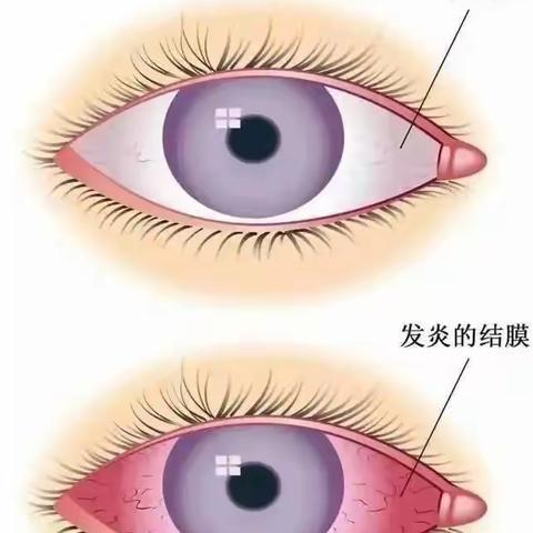 【家校联动】凯里市第四小学急性出血性角膜炎预防指南