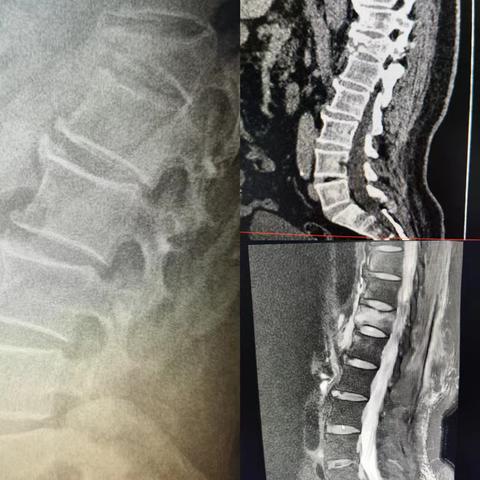 重铸生活希望：铜仁袁家寺骨科医院脊柱外科胸12椎体爆裂性骨折手术成功案例
