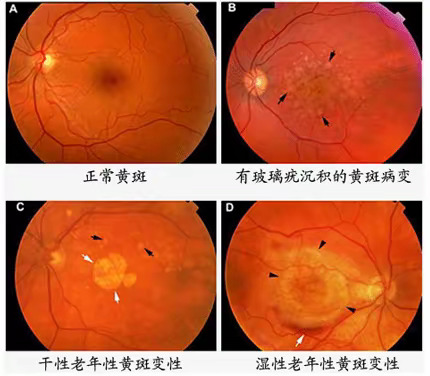 深入了解黄斑变性