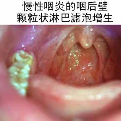 慢性咽炎，您关注过吗？