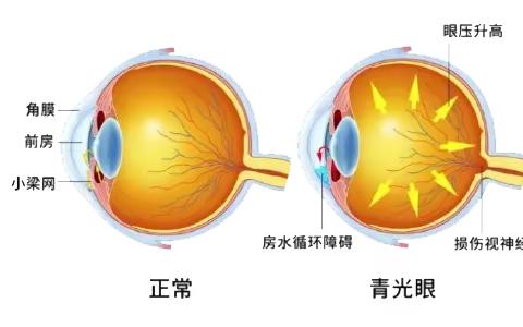 常见眼病科普