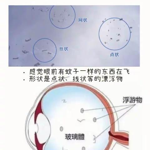 眼睛里咋会有虫子飞？