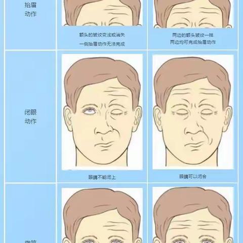 得了面瘫莫惊慌 正确护理早康复