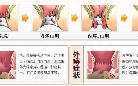 pph吻合器痔环切术，对痔疮的微创治疗