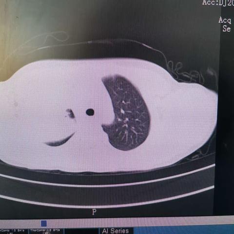 重症支原体肺炎，支气管镜治疗促康复！