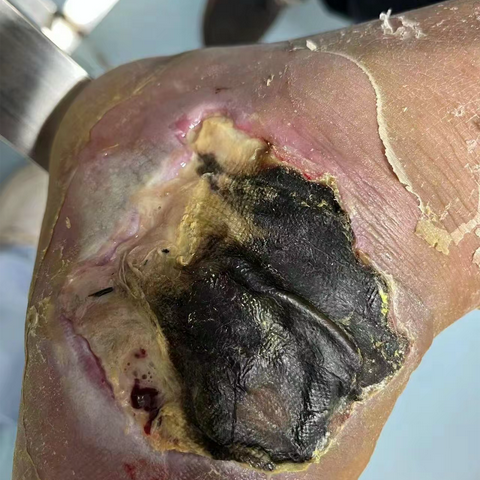 锦旗背后的故事-糖尿病足患者的康复感恩