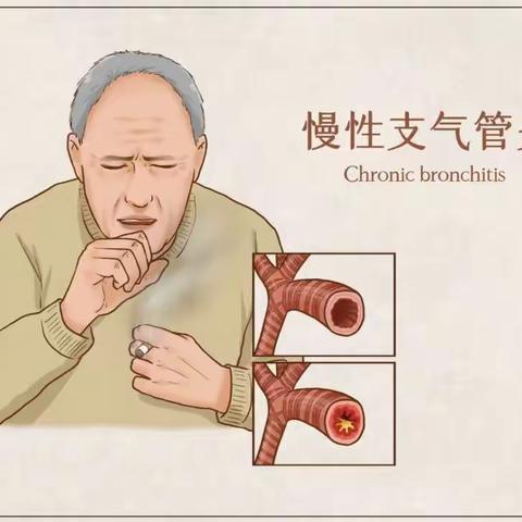 慢性支气管炎健康教育