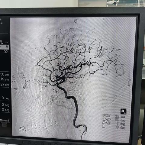 平利县医院开展脑梗死静脉溶栓—桥接机械取栓治疗