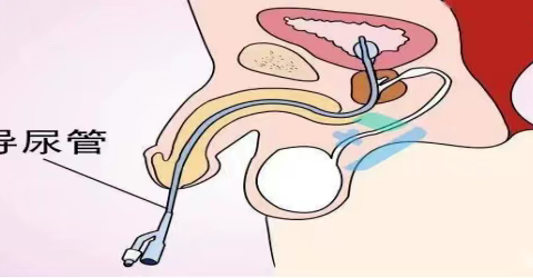留置导尿护理小常识