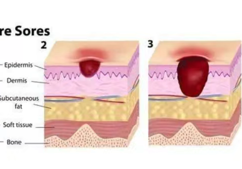 压力性损伤的预防