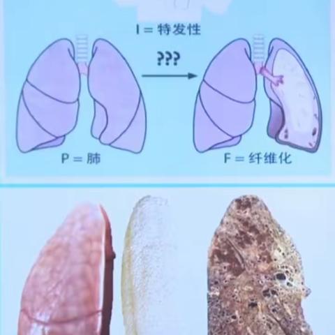 间质性肺病知多少