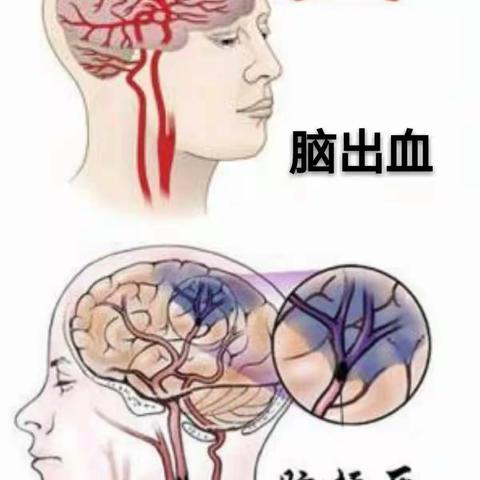 南阳医专一附院东院区神经内分泌科 脑卒中重要的检测指标哪些？