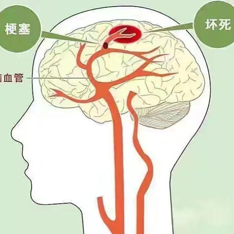 健康科普第七期——带您了解脑梗死