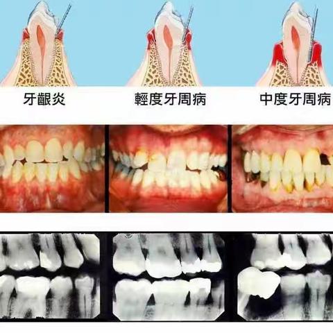 9.20日全国爱牙日 ——口腔科开展爱牙日“洗牙”特惠活动