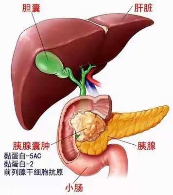 急性胰腺炎疾病宣教