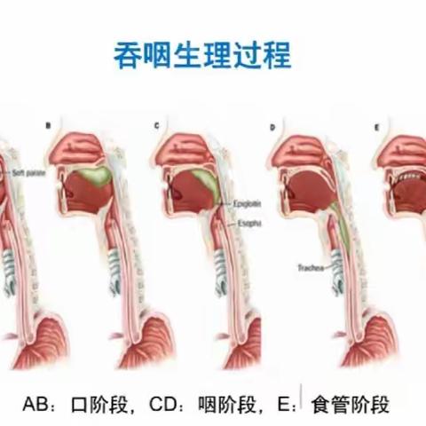 拒绝吞咽障碍   重“拾”人间美味