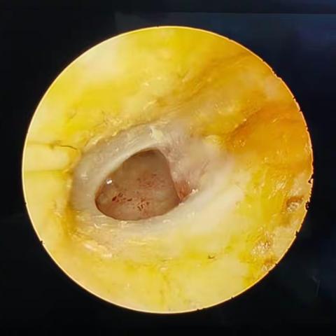 双镜联合治疗中耳乳突炎，让创伤更小，听力恢复更好
