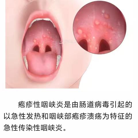 健康第一课：疱疹性咽峡炎/手足口预防小常识