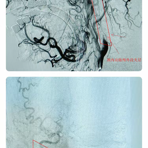 从业以来最难做的一例颈内动脉颅外段夹层----大脑中动脉串联闭塞