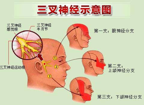 天下第一痛——三叉神经痛，你了解多少，你中招了吗