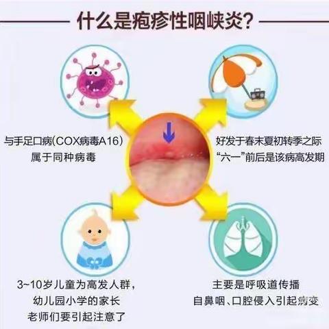 疱疹性咽颊炎的预防及措施——长春市南关区花田悦幼儿园