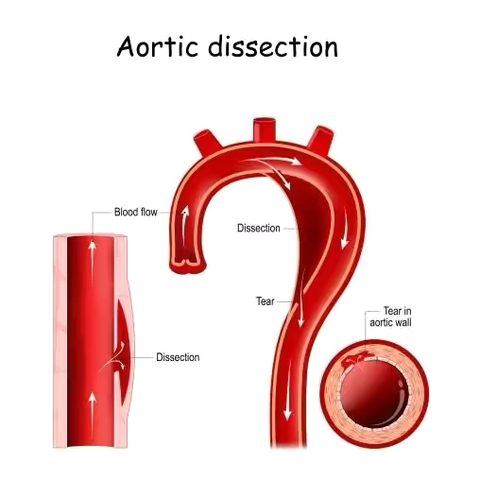 夺命“三明治”主动脉夹层，我们该如何预防