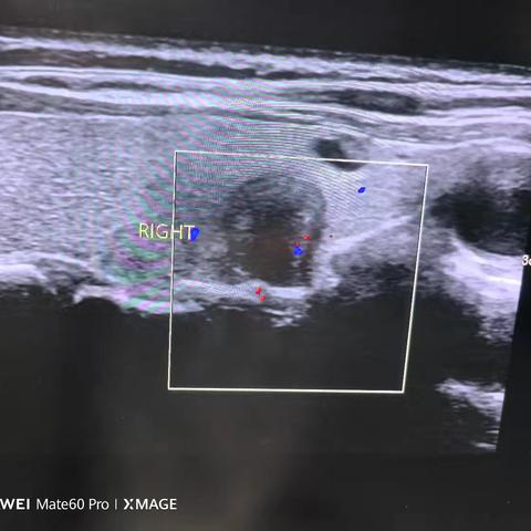 甲状腺结节超声科普