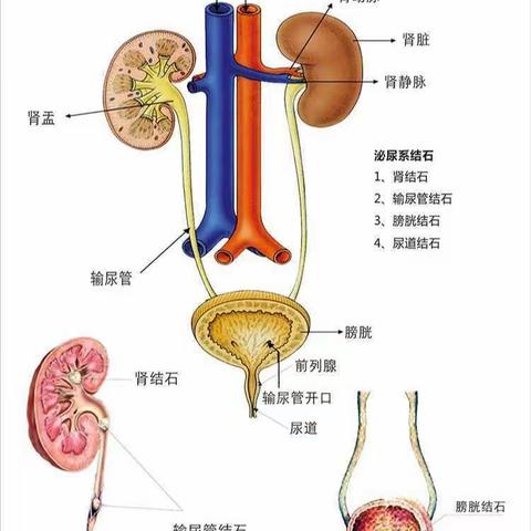 泌尿系结石